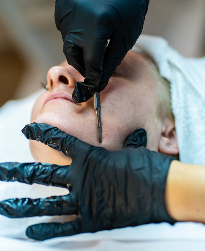Microneedling